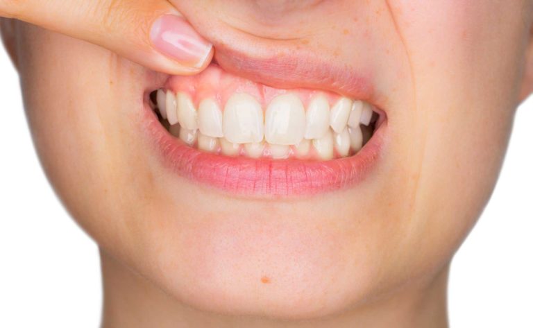 Women checking her gums | Gum Health 101