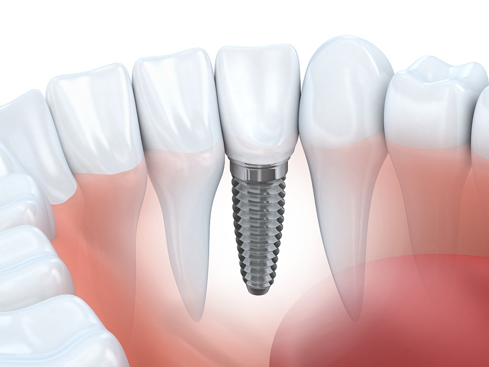 Dental Implant Myths