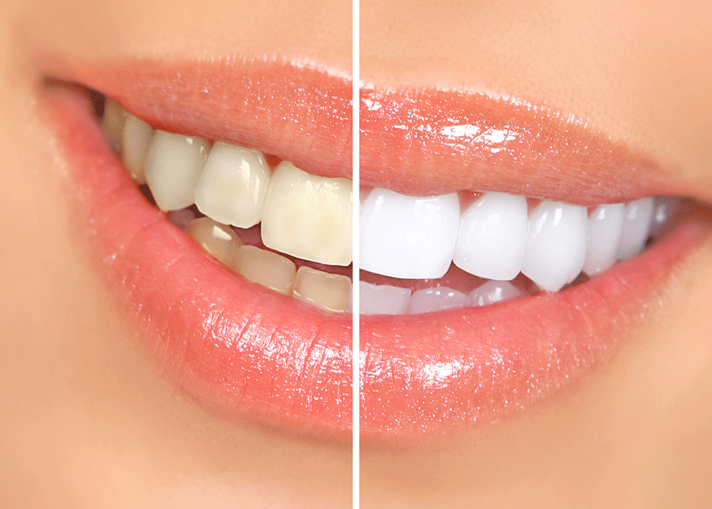 How Does Professional Teeth Whitening Work?