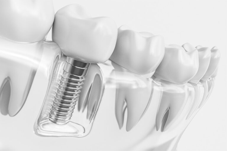 Dental Implants: A Safe and Permanent Way to Replace Missing Teeth